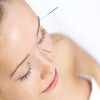 acupuncture facial pic